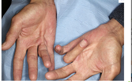 dupuytrens-contracture-photo2